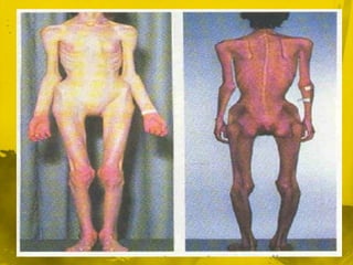 DEP ModeradoLos síntomas y signos anteriores se exacerbanEl niño se torna irritable y duerme con los ojos entreabiertos, la pérdida de peso se acentúa, las diarreas y las infecciones son frecuentes (rinorrea, faringitis, otitis), la fontanela y los ojos se hunden; la piel y el tejido subcutáneo pierden turgencia y elasticidad, se presenta hipotrofia muscular y a veces comienza a aparecer edema.