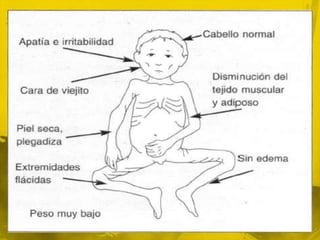 DEP Grave (Marasmo)El marasmo predomina en los lactantes de entre seis y 18 meses de edadEs el resultado de una ingestión deficiente y crónica de energía, proteínas, vitaminas y nutrimentos inorgánicos.Existe una falta de amamantamiento o el empleo de sustitutos de la leche humana muy diluidos que conducen a una situación de pérdida de peso continua.