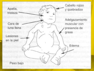 DEP Grave (Kwashiorkor)Es consecuencia también de una deficiencia de energía y micronutrientes, a la cual se suma una ingestión inadecuada de proteínas.Se presenta con mayor frecuencia en la etapa posterior al destete, en lactantes mayores o prescolares.