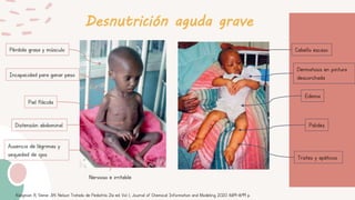 Desnutrición aguda grave
Pérdida grasa y músculo
Incapacidad para ganar peso
Piel flácida
Ausencia de lágrimas y
sequedad de ojos
Distensión abdominal
Nervioso e irritable
Edema
Dermatosis en pintura
descorchada
Cabello escaso
Tristes y apáticos
Palidez
Kliegman R, Geme JW. Nelson Tratado de Pediatría. 21a ed. Vol. 1, Journal of Chemical Information and Modeling. 2020. 1689–1699 p.
 