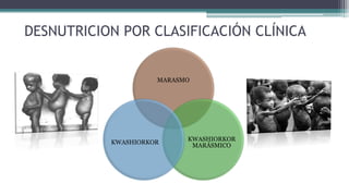 DESNUTRICION POR CLASIFICACIÓN CLÍNICA
MARASMO
KWASHIORKOR
MARÁSMICO
KWASHIORKOR
 