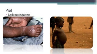 Piel
• Lesiones cutáneas
 