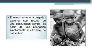 • El marasmo es una delgadez
extrema que resulta de
una desnutrición severa, es
decir, de una aportación
ampliamente insuficiente de
nutrientes
 