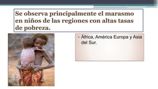 Se observa principalmente el marasmo
en niños de las regiones con altas tasas
de pobreza.
• África, América Europa y Asia
del Sur.
 