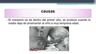 causas
• El marasmo se da dentro del primer año, se produce cuando la
madre deja de amamantar al niño a muy temprana edad.
 