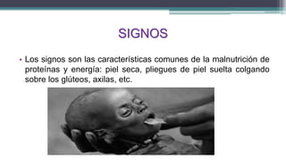 SIGNOS
• Los signos son las características comunes de la malnutrición de
proteínas y energía: piel seca, pliegues de piel suelta colgando
sobre los glúteos, axilas, etc.
 