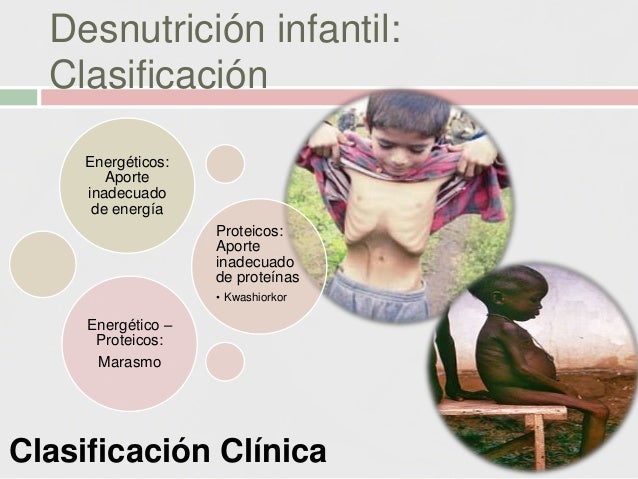 Desnutricion Infantil Pediatria