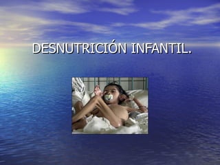 DESNUTRICIÓN INFANTIL.
 