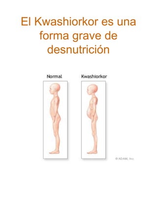 El Kwashiorkor es una
forma grave de
desnutrición

 