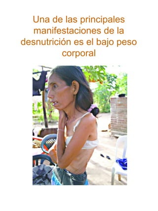Una de las principales
manifestaciones de la
desnutrición es el bajo peso
corporal

 