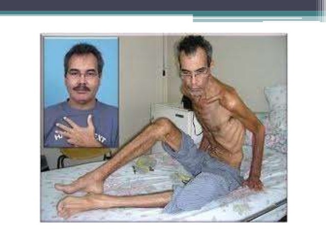 Desnutricion