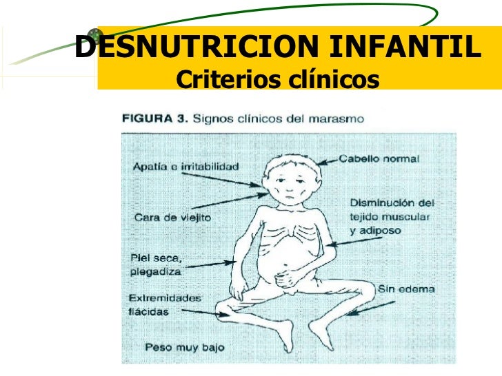 Resultado de imagen para desnutricion infantil causas
