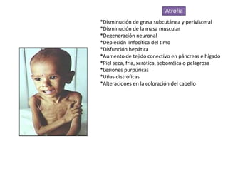 Atrofia
*Disminución de grasa subcutánea y perivisceral
*Disminución de la masa muscular
*Degeneración neuronal
*Depleción linfocítica del timo
*Disfunción hepática
*Aumento de tejido conectivo en páncreas e hígado
*Piel seca, fría, xerótica, seborréica o pelagrosa
*Lesiones purpúricas
*Uñas distróficas
*Alteraciones en la coloración del cabello
 