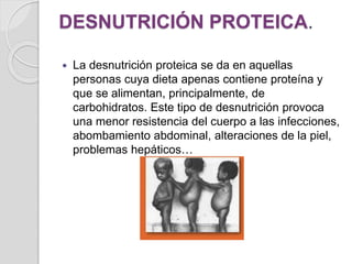 DESNUTRICIÓN PROTEICA.
 La desnutrición proteica se da en aquellas
personas cuya dieta apenas contiene proteína y
que se alimentan, principalmente, de
carbohidratos. Este tipo de desnutrición provoca
una menor resistencia del cuerpo a las infecciones,
abombamiento abdominal, alteraciones de la piel,
problemas hepáticos…
 