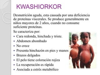 Desnutrición aguda, esta causada por una deficiencia
de proteínas viscerales. Se produce generalmente en
niños mayores de 2 años, cuando no consume
suficiente proteínas.
Se caracteriza por:
 Cara redonda, hinchada y triste.
 Abdomen abombado
 No crece
 Presenta hinchazón en pies y manos
 Brazos delgados
 El pelo tiene coloración rojiza
 La recuperación es rápida
 Asociada a estrés metabólico
 