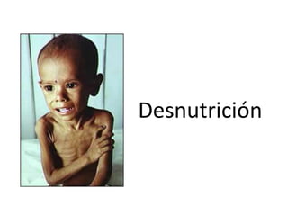 Desnutrición
 