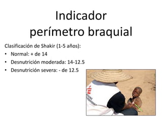 Indicador
perímetro braquial
Clasificación de Shakir (1-5 años):
• Normal: + de 14
• Desnutrición moderada: 14-12.5
• Desnutrición severa: - de 12.5
 