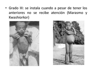 • Grado III: se instala cuando a pesar de tener los
anteriores no se recibe atención (Marasmo y
Kwashiorkor)
 