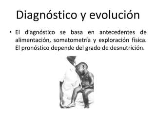Diagnóstico y evolución
• El diagnóstico se basa en antecedentes de
alimentación, somatometría y exploración física.
El pronóstico depende del grado de desnutrición.
 