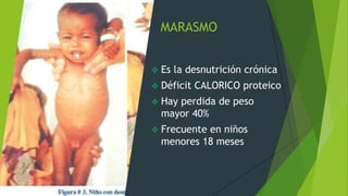 MARASMO
 Es la desnutrición crónica
 Déficit CALORICO proteico
 Hay perdida de peso
mayor 40%
 Frecuente en niños
menores 18 meses
 