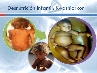 Desnutrición infantil: Kwashiorkor
Desnutrición
edematosa
hipoalbuminémica
Manifestaciones clínicas:
• El peso de niño esta entre un 60 a
80% del peso esperado para la
edad (debido a edema)
• Edema que deja fóvea que va en
ascenso
• examen físico: mantenimiento
relativo del tejido adiposo
subcutáneo, con atrofia muscular
• Cabello ralo, debíl y facil de
arrancar de color marrón-pardo a
pardo-amarillento sin brillo (signo
de la bandera)
 