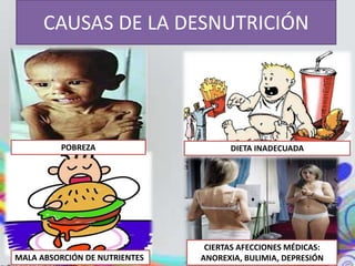 CAUSAS DE LA DESNUTRICIÓN 
POBREZA DIETA INADECUADA 
MALA ABSORCIÓN DE NUTRIENTES 
CIERTAS AFECCIONES MÉDICAS: 
ANOREXIA, BULIMIA, DEPRESIÓN 
 