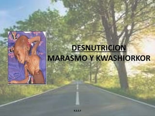 DESNUTRICION
MARASMO Y KWASHIORKOR
K.E.E.F
 