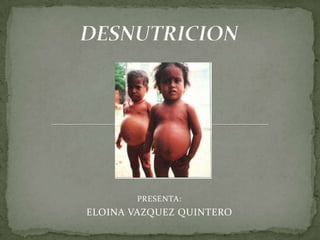 DESNUTRICION PRESENTA: ELOINA VAZQUEZ QUINTERO 
