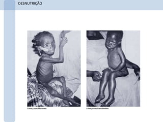 DESNUTRIÇÃO
 