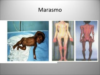 Marasmo
 