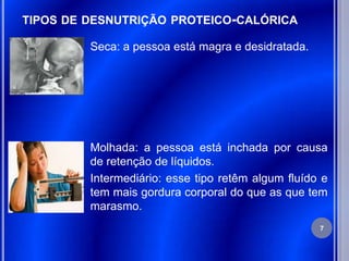 TIPOS DE DESNUTRIÇÃO PROTEICO-CALÓRICA

         Seca: a pessoa está magra e desidratada.




         Molhada: a pessoa está inchada por causa
         de retenção de líquidos.
         Intermediário: esse tipo retêm algum fluído e
         tem mais gordura corporal do que as que tem
         marasmo.
                                                    7
 