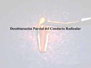 Desobturación Parcial del Conducto Radicular
 