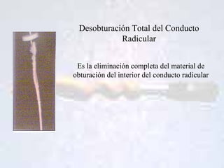 Desobturación Total del Conducto
Radicular
Es la eliminación completa del material de
obturación del interior del conducto...