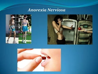 Anorexia Nerviosa
 