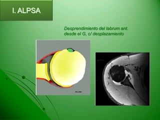 Desordenes del hombro | PPT