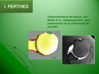 Desordenes del hombro | PPT