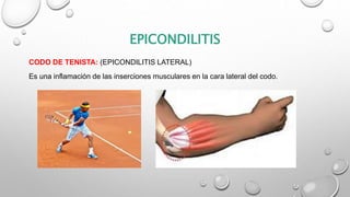EPICONDILITIS
CODO DE TENISTA: (EPICONDILITIS LATERAL)
Es una inflamación de las inserciones musculares en la cara lateral del codo.
 