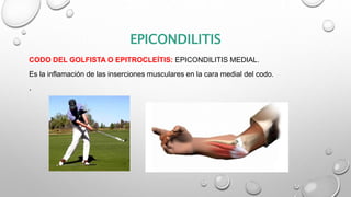 EPICONDILITIS
CODO DEL GOLFISTA O EPITROCLEÍTIS: EPICONDILITIS MEDIAL.
Es la inflamación de las inserciones musculares en la cara medial del codo.
.
 