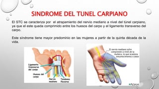 SINDROME DEL TUNEL CARPIANO
El STC se caracteriza por el atrapamiento del nervio mediano a nivel del túnel carpiano,
ya que el este queda comprimido entre los huesos del carpo y el ligamento transverso del
carpo.
Este síndrome tiene mayor predominio en las mujeres a partir de la quinta década de la
vida.
 