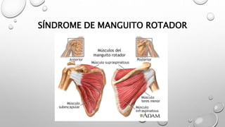 SÍNDROME DE MANGUITO ROTADOR
 