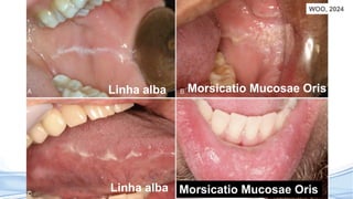 WOO, 2024
Linha alba
Linha alba
Morsicatio Mucosae Oris
Morsicatio Mucosae Oris
 