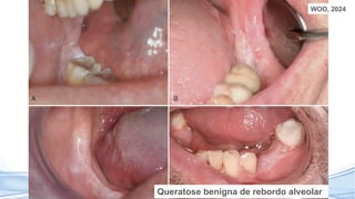 WOO, 2024
Queratose benigna de rebordo alveolar
 
