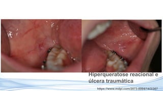 https://www.mdpi.com/2073-8994/14/2/307
Hiperqueratose reacional e
úlcera traumática
 