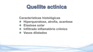 Características histológicas
Hiperqueratose, atrofia, acantose
Elastose solar
Infiltrado inflamatório crônico
Vasos dilatados
 