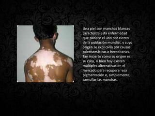 Una piel con manchas blancas
caracteriza esta enfermedad
que padece el uno por ciento
de la población mundial, y cuyo
origen se explicaría por causas
psicosomáticas o hereditarias.
Tan incierto como su origen es
su cura, si bien hoy existen
múltiples alternativas en el
mercado para recuperar esa
pigmentación o, simplemente,
camuflar las manchas.
 