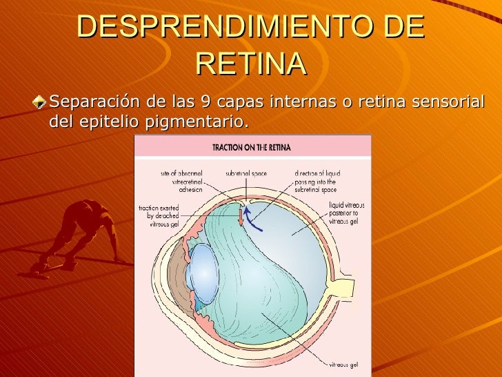 Desprendimiento De Retina Desprendimiento De Retina