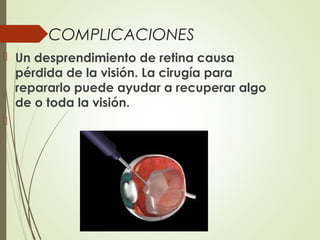 COMPLICACIONES
 Un desprendimiento de retina causa
pérdida de la visión. La cirugía para
repararlo puede ayudar a recuperar algo
de o toda la visión.

 