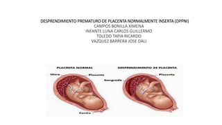 DESPRENDIMIENTO PREMATURO DE PLACENTA NORMALMENTE INSERTA (DPPNI)
CAMPOS BONILLA XIMENA
INFANTE LUNA CARLOS GUILLERMO
TOLEDO TAPIA RICARDO
VAZQUEZ BARRERA JOSE DALI
 