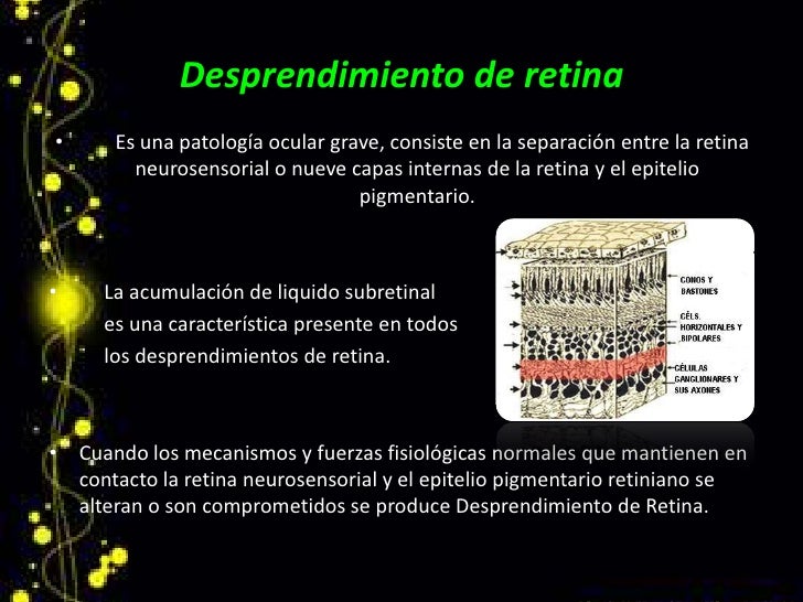 Desprendimiento de Retina. Desprendimiento de Retina.
