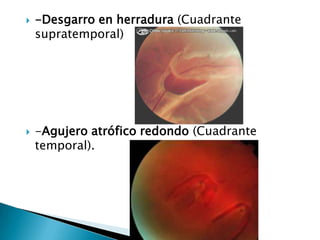 



-Desgarro en herradura (Cuadrante
supratemporal)

-Agujero atrófico redondo (Cuadrante
temporal).

 